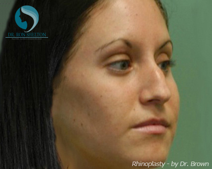 Rhinoplasty New York City - Before Case 3