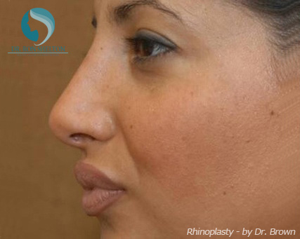 Rhinoplasty New York City - After Case 6