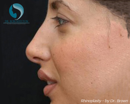 Rhinoplasty New York City - Before Case 6