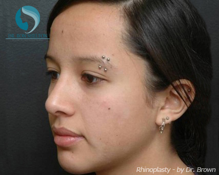 Rhinoplasty New York City - After Case 1