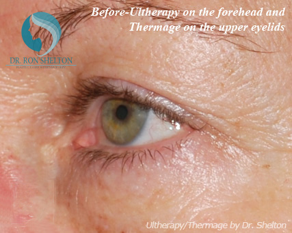 <?php echo $pk; ?> - Before Case 2