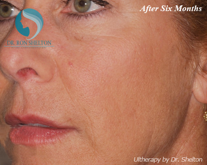 <?php echo $pk; ?> - After Case 5