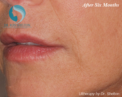 <?php echo $pk; ?> - After Case 6