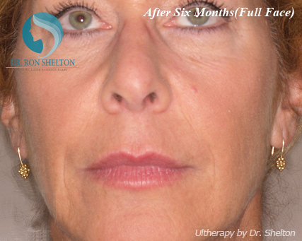 <?php echo $pk; ?> - After Case 4