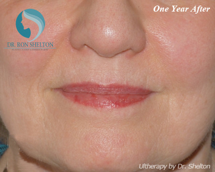 <?php echo $pk; ?> - After Case 1