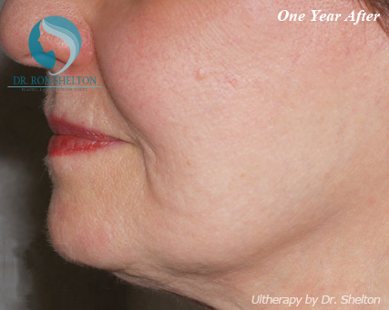 <?php echo $pk; ?> - After Case 2