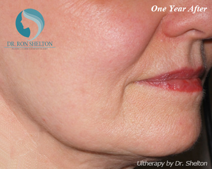 <?php echo $pk; ?> - After Case 3