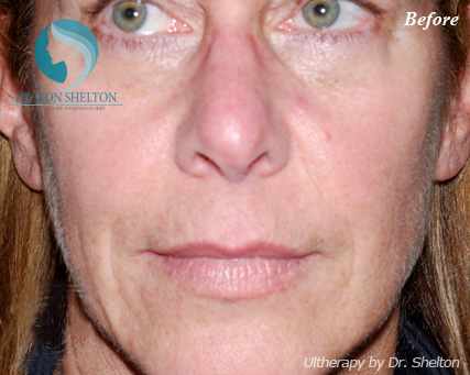 <?php echo $pk; ?> - Before Case 4