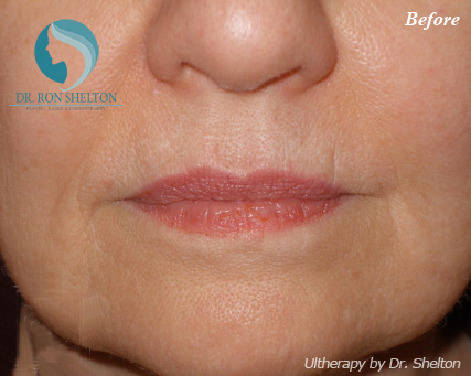 <?php echo $pk; ?> - Before Case 1