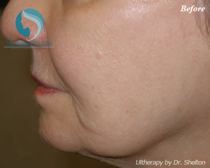 <?php echo $pk; ?> - Before Case 2