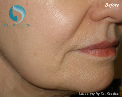 <?php echo $pk; ?> - Before Case 3