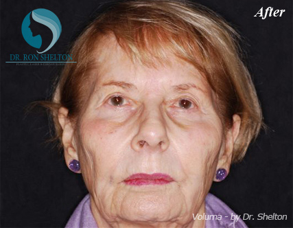 <?php echo $pk; ?> - After Case 1