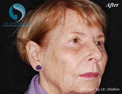 <?php echo $pk; ?> - After Case 3