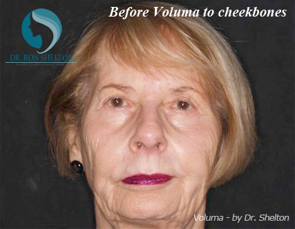 <?php echo $pk; ?> - Before Case 1