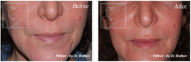 <?php echo $pk; ?> - Before and After