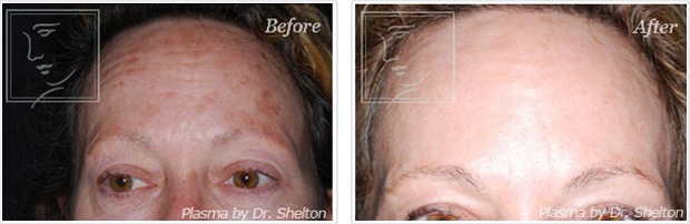 <?php echo $pk; ?> - Before and After