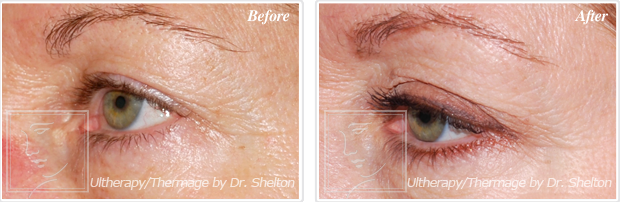 <?php echo $pk; ?> - Before and After