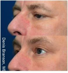 Skin Tightening with ThermiSmooth NYC - Before After Case 3