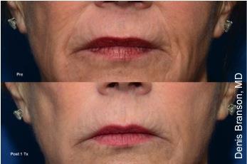 Skin Tightening with ThermiSmooth NYC - Before After Case 1