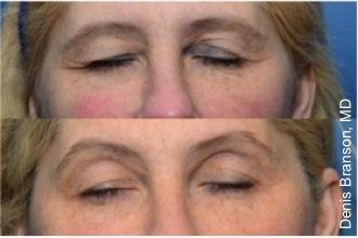 Skin Tightening with ThermiSmooth NYC - Before After Case 2