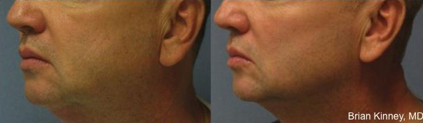 ThermiTight NYC - Before After Case 1