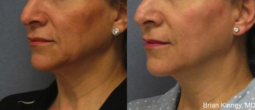 ThermiTight NYC - Before After Case 2