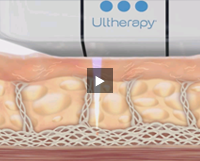 <?php echo $pk; ?> - Ultherapy Video 4