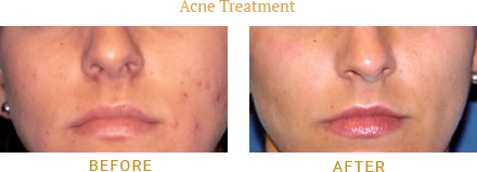 Acne Before After Case 01