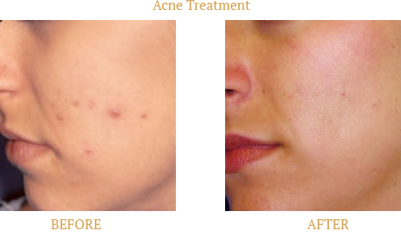 Acne Before After Case 02