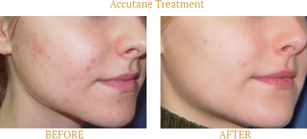 Acne Before After Case 03