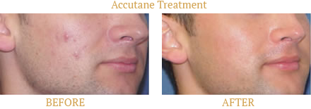 Acne Before After Case 07