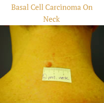 Basal Cell Carcinoma On The Neck