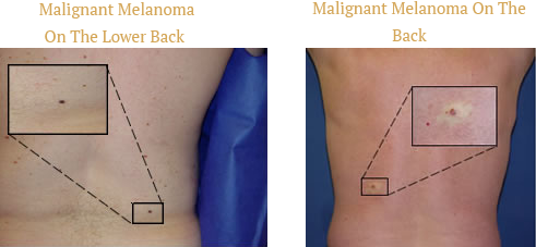 Malignant Melanoma On The Back Malignant Melanoma On The Back