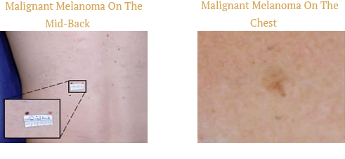 Malignant Melanoma On The Mid-Back and Chest Malignant Melanoma On The Mid-Back and Chest
