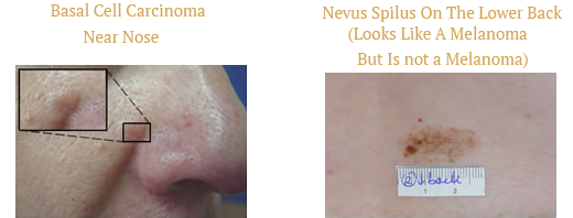 Basal Cell Carcinoma Near Nose and Nevus Spilus On The Lower Back Basal Cell Carcinoma Near Nose and Nevus Spilus On The Lower Back