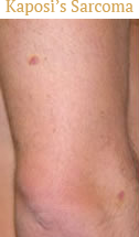 Kaposi’s Sarcoma Kaposi’s Sarcoma