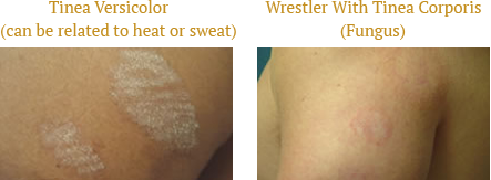 Tinea Versicolor and Wrestler With Tinea Corporis 