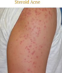 Steroid Acne