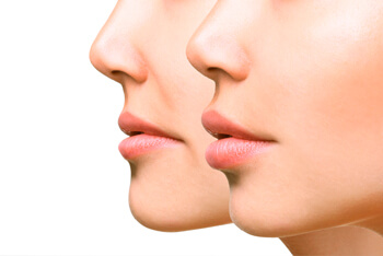 Cropped image of two faces for treatment via fillers
