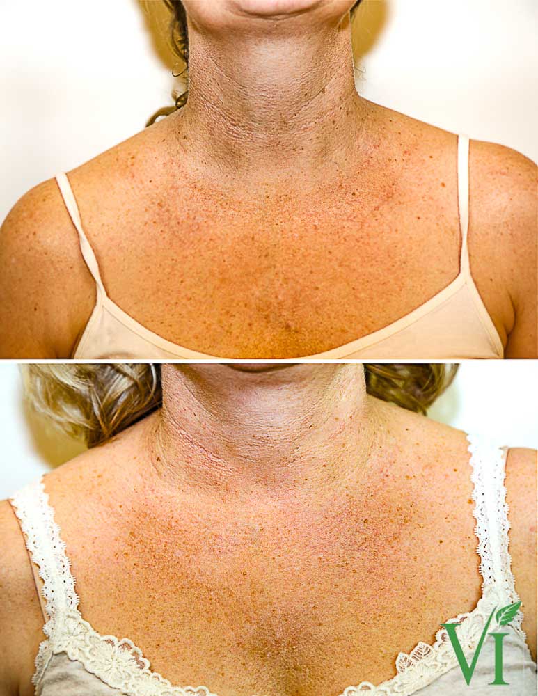 Body peeling