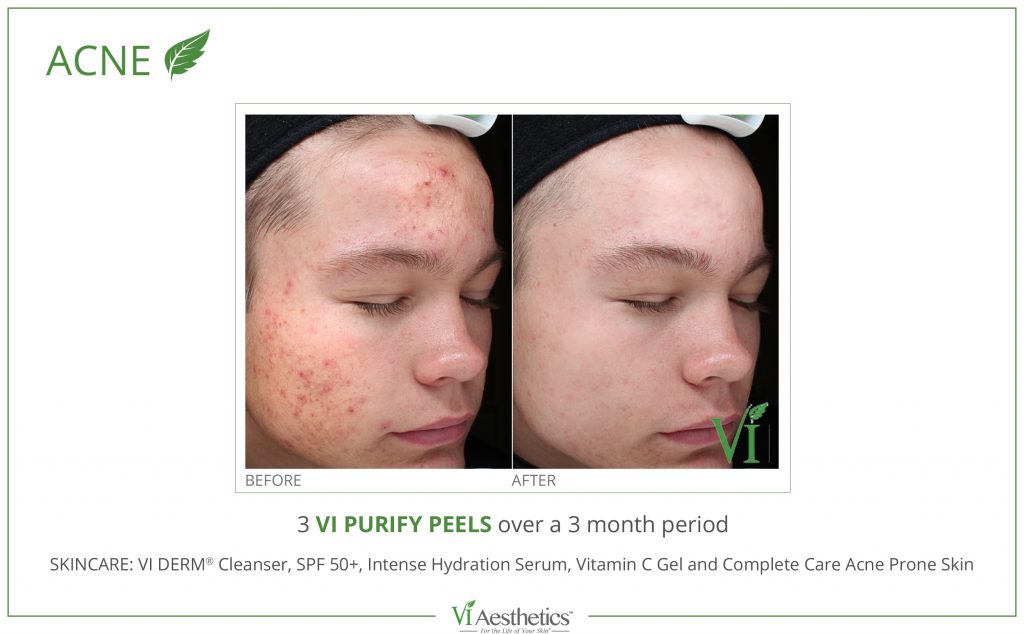 VI Peel Acne