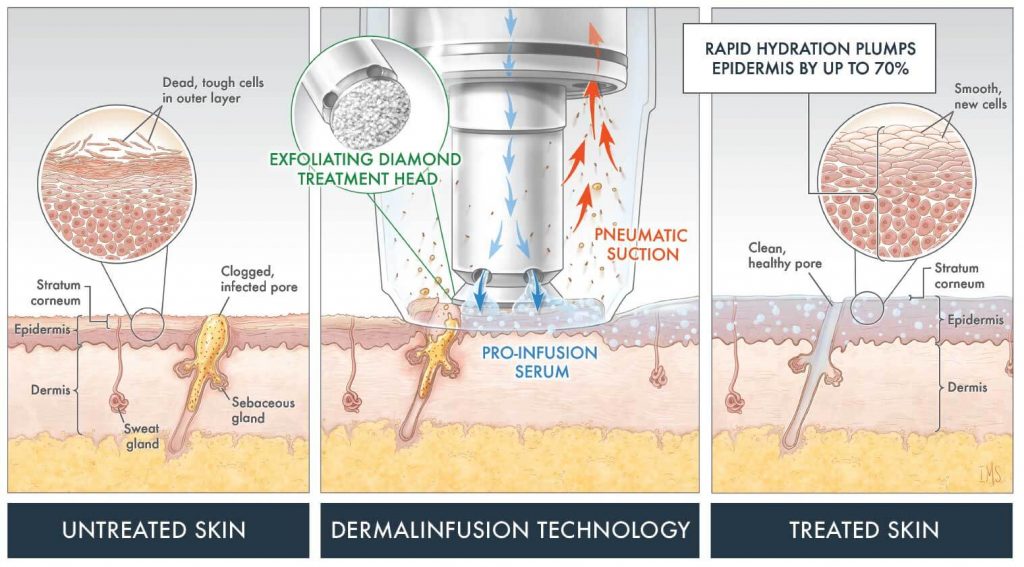 Dermal Infusion graphic illustration