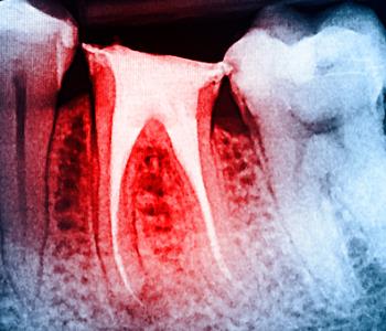 Decayed teeth can saved by Root canals treatment from Dentist in Central HK