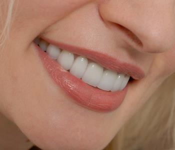 dental Veneer cosmetic dental treatment from Dentist in Central HK
