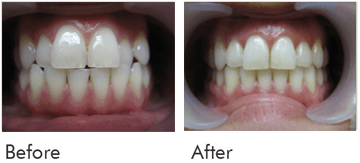 Invisalign Treatment Before After Case 01