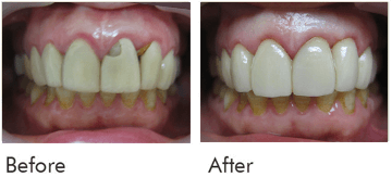 Veneers Treatment Before After Case 01