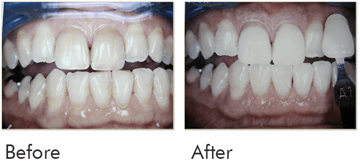 Teeth Whitening Before After Case 04
