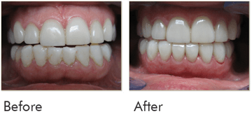 Cosmetic Make Over Before After Case 03