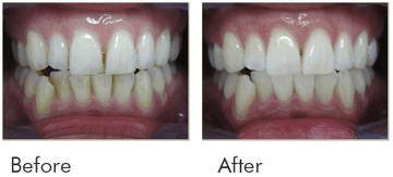 Teeth Whitening Before After Case 07