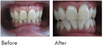 Teeth Whitening Before After Case 03